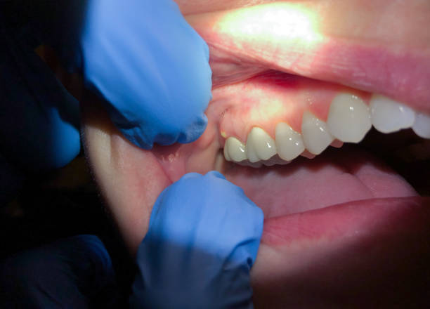 Best Emergency Root Canal Treatment in Moulton, AL